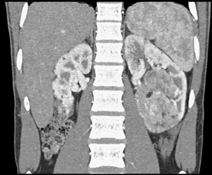 Left Renal Angiomyolipoma (AML) - CTisus CT Scan