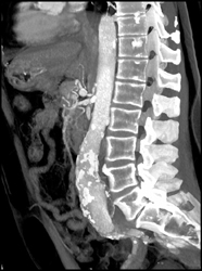 Abdominal Aortic Aneurysm (AAA) - CTisus CT Scan