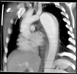 Aortic Dissection - CTisus CT Scan