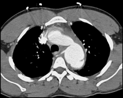 Aortic Dissection - CTisus CT Scan