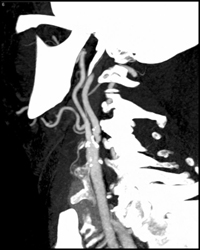 Carotid Stenosis - CTisus CT Scan