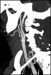 Carotid Stenosis - CTisus CT Scan