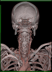 Carotid Stenosis - CTisus CT Scan