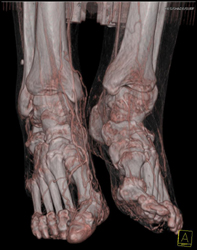 Runoff CTA - CTisus CT Scan