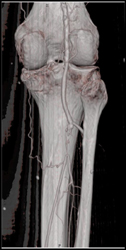 Disease at Trifurcation - CTisus CT Scan