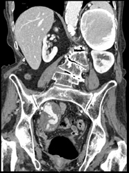 Internal Iliac Aneurysm - CTisus CT Scan