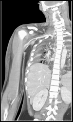 Patent Brachial Artery - CTisus CT Scan