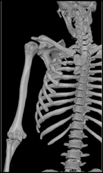 Vessels Removed With VRT of Bone - CTisus CT Scan