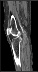 Occluded Popliteal Artery - CTisus CT Scan