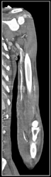 Patent Vasculature - CTisus CT Scan