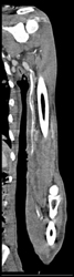 Patent Aa and Vein - CTisus CT Scan