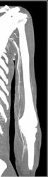 MIP of Axillary Vessels - CTisus CT Scan