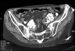 Enlarging Right Iliac Aneurysm and Coiled Left Iliac Aneurysm - CTisus CT Scan