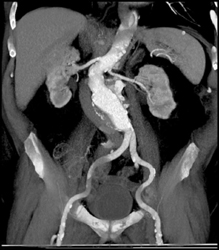 Abdominal Aortic Aneurysm (AAA) - CTisus CT Scan