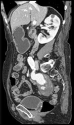 Abdominal Aortic Aneurysm (AAA) With Leak - CTisus CT Scan