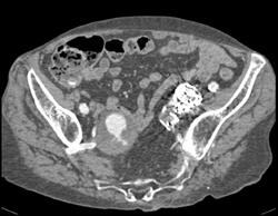 Leaking Internal Iliac Artery Aneurysm - CTisus CT Scan