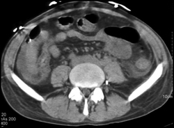 Venous Line in Poor Position - CTisus CT Scan