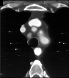 Takayasu's Arteritis - CTisus CT Scan