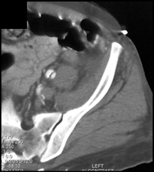 Iliac Artery Dissection - CTisus CT Scan