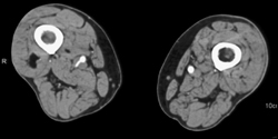 Clotted Right Superficial Femoral Artery (SFA) - CTisus CT Scan