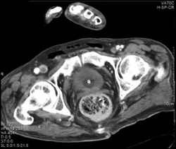 Right Femoral Vein Clot - CTisus CT Scan