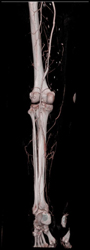 Stent in Popliteal Artery That Is Patent - CTisus CT Scan