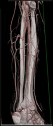 Normal Runoff - CTisus CT Scan