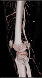 Stent in Popliteal Artery - CTisus CT Scan