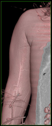 Iv in Arm - CTisus CT Scan