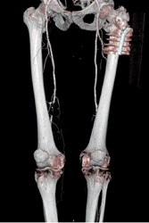 Occluded Superficial Femoral Artery (SFA) - CTisus CT Scan