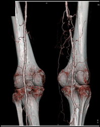 Occluded SFA With Collaterals - CTisus CT Scan