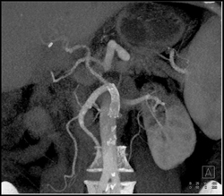 Stent in Mesenteric Vessel - CTisus CT Scan