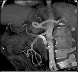 Stent in Bypass Graft - CTisus CT Scan