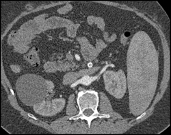 Occluded Stent - CTisus CT Scan