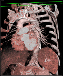 Superior Intercostal Artery - CTisus CT Scan