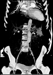 Diseased Femoral Vessels -right and Left - CTisus CT Scan