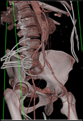 Diseased Iliac Vessels - CTisus CT Scan