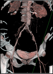 Diseased Iliac Arteries - CTisus CT Scan