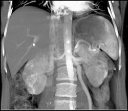 Right Hepatic Artery Arises Directly Off the Aorta - CTisus CT Scan