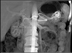 Splenic Artery Aneurysm - CTisus CT Scan