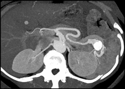 Splenic Artery Aneurysm - CTisus CT Scan