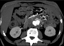 Endovascular Stent With Endoleak - CTisus CT Scan