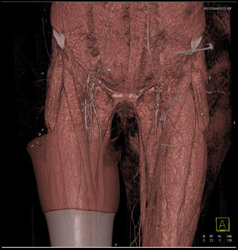 CTA of Thigh Shows Muscles - CTisus CT Scan