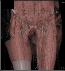 Patent Left Superficial Femoral Artery (SFA) With Diseased Right SFA - CTisus CT Scan