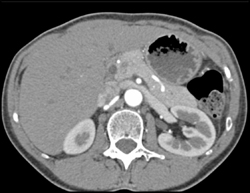 Superior Mesenteric Artery (SMA) Syndrome - CTisus CT Scan