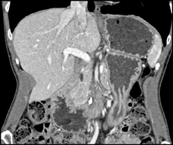 Superior Mesenteric Artery (SMA) Syndrome - CTisus CT Scan