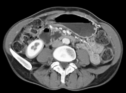 Superior Mesenteric Artery (SMA) Syndrome - CTisus CT Scan