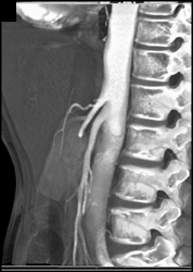 Superior Mesenteric Artery (SMA) Syndrome - CTisus CT Scan