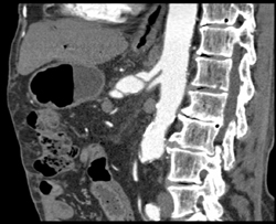 Celiac Artery Aneurysm - CTisus CT Scan