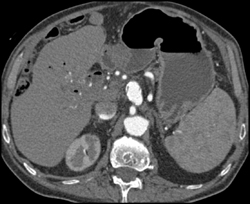 Celiac Artery Aneurysm - CTisus CT Scan